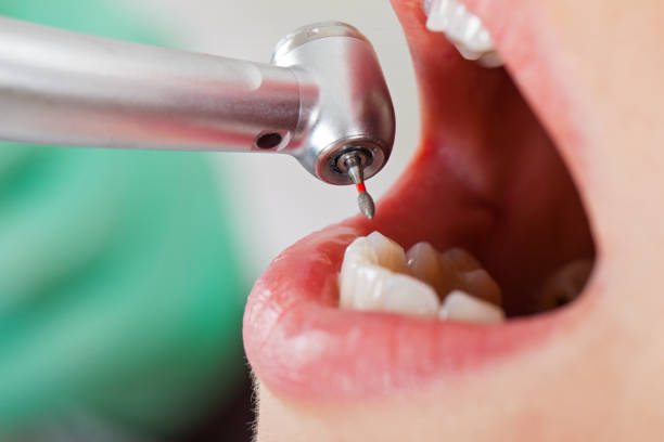Best Dentist for Tooth Abscess  in Logan, IA